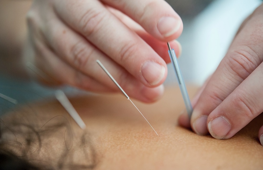 Dry Needling  Palm Beach Gardens, FL 